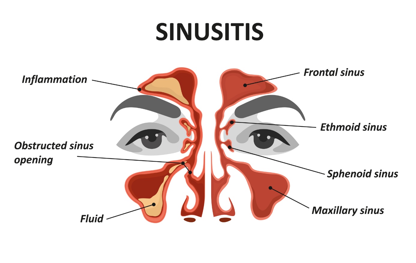 Geanimeerd model/beeld van sinusitis en bijholteontsteking