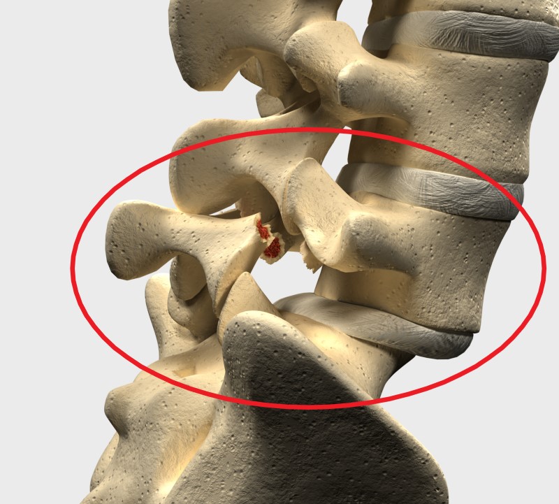 Spondylolisthesis in het lumbale gebied L5 en S1 - model van het wervelskelet