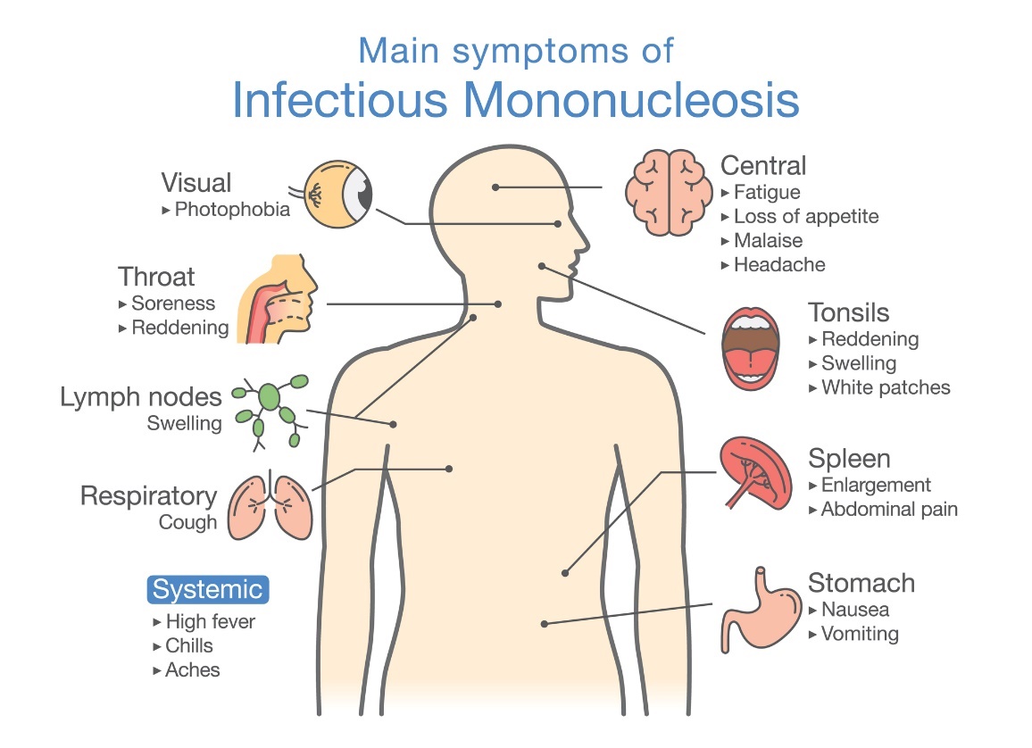 Symptomen van infectieuze mononucleose