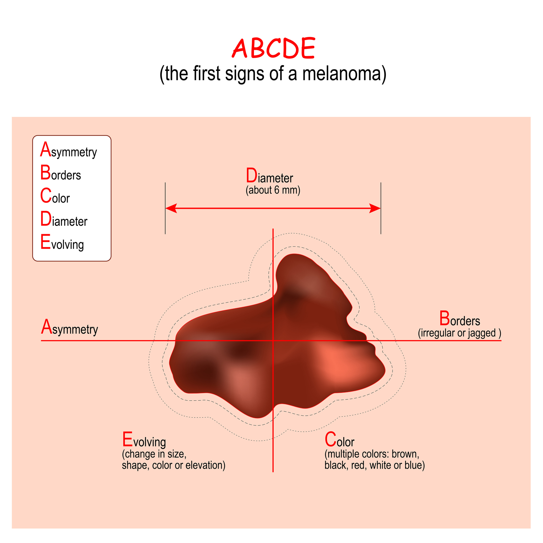 ABCDE-algoritme