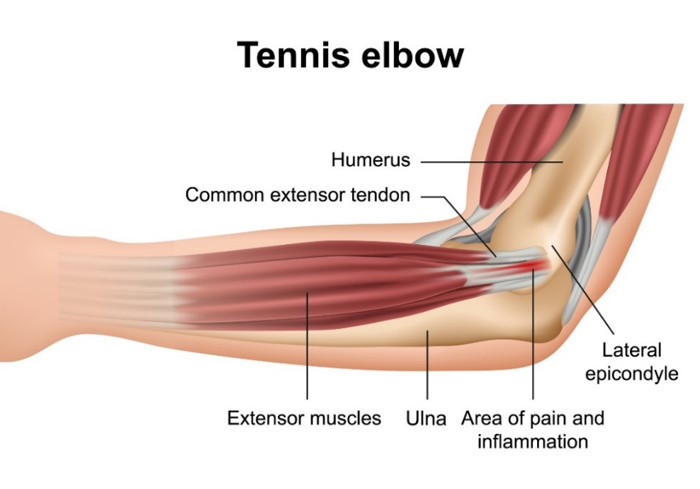 Tenniselleboog (epicondylitis lateralis): de botten van het ellebooggewricht, de strekspieren van de onderarm, de epicondylus lateralis en de plaats van de primaire pijn.