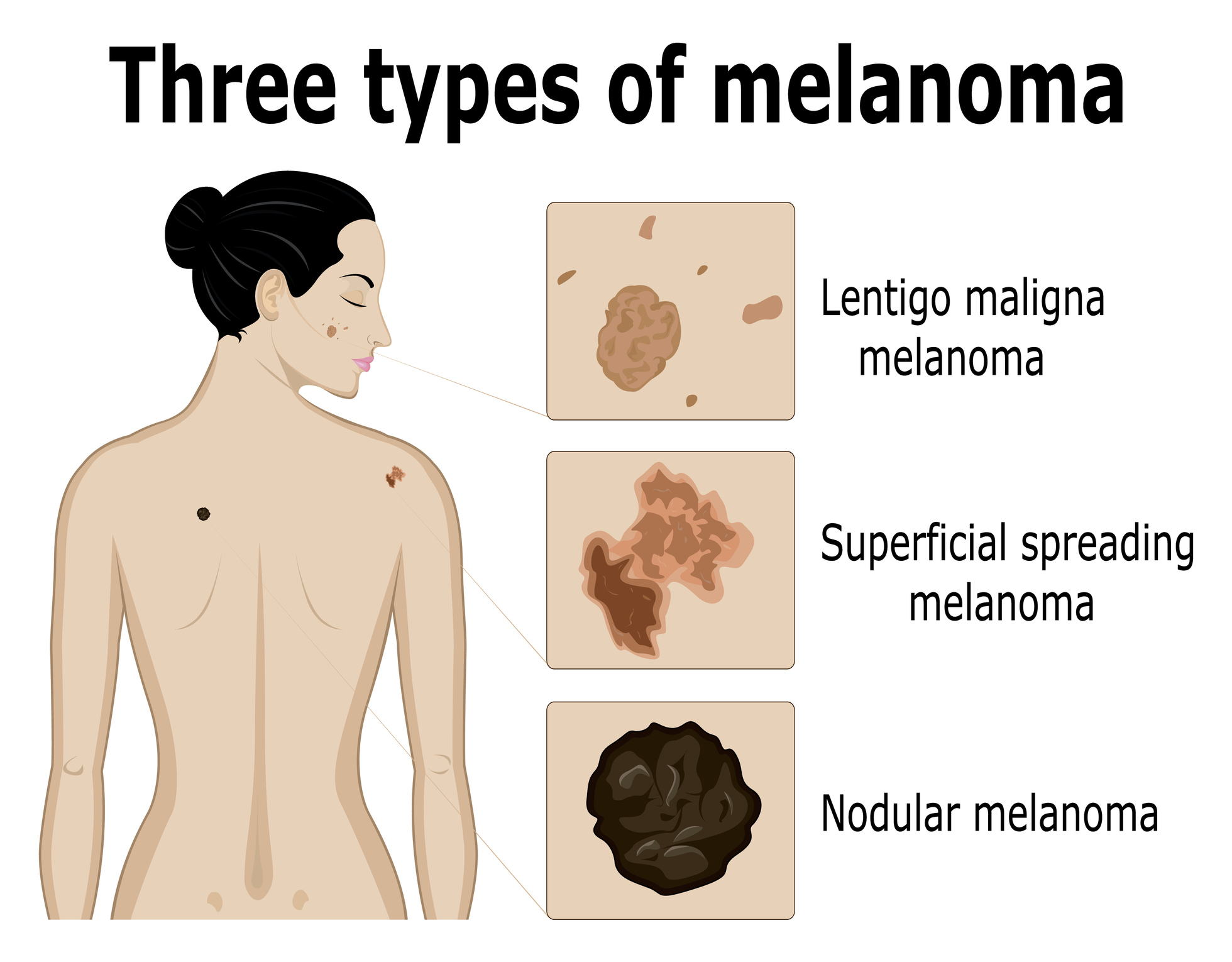 Beeldvorming van de drie soorten melanoom