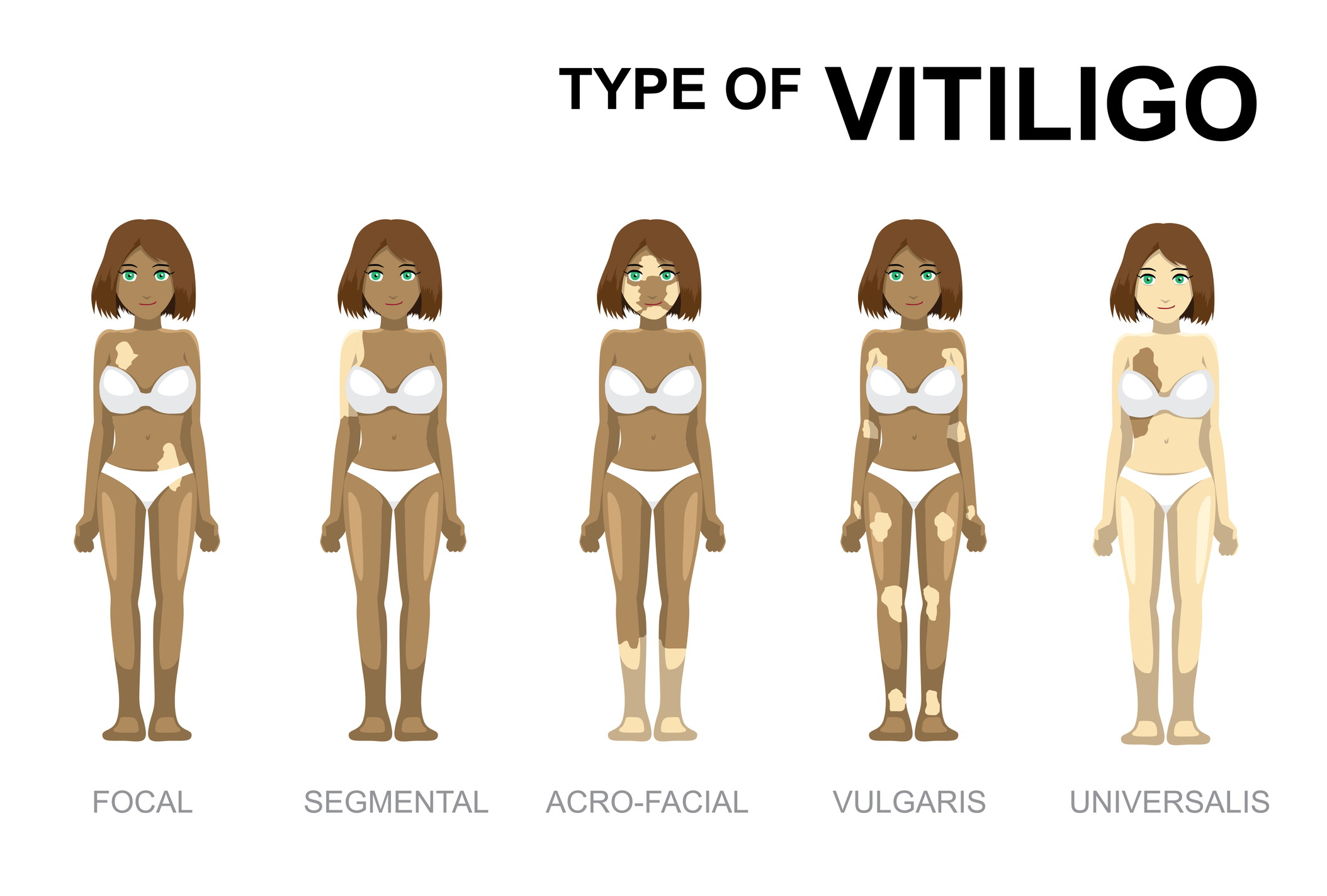 Soorten vitiligo