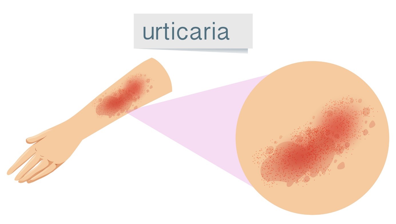 Urticaria, urticaria, urticaria, urticaria, urticaria