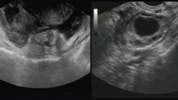 USG - sonografie van de buik - beeld tijdens onderzoek, beeldvorming van de baarmoeder en buitenbaarmoederlijke zwangerschap