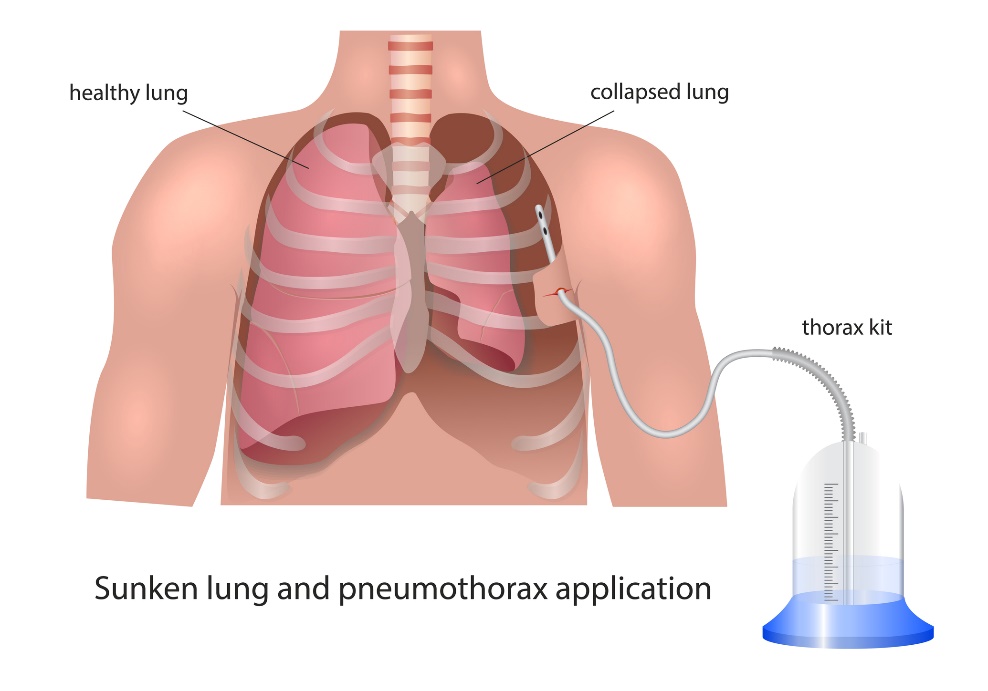 Visualisatie van pleurale drainage bij pneumothorax: gezonde long, ingeklapte long en drainageapparaat