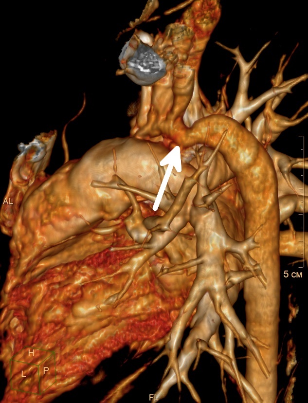 Visualisatie van coarctatie (vernauwing) van de aorta in het neergaande deel van het hartvat.