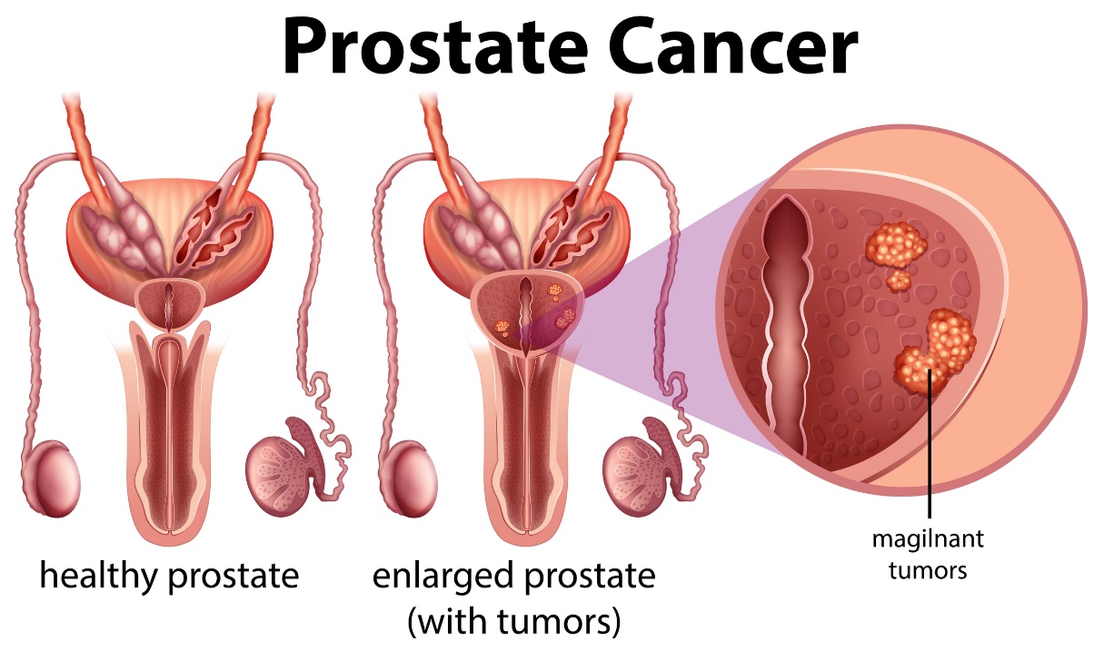 Prostaatkanker: gezonde prostaat en vergrote prostaat met tumor