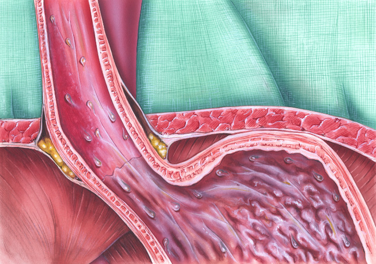 anatomisch afgebeelde sluitspier op de slokdarm