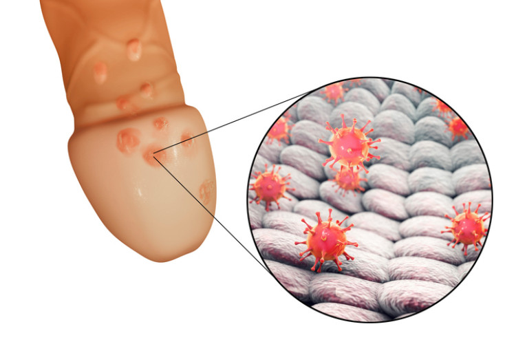 herpes genitalis op de penis en herpesvirus op microscopisch niveau