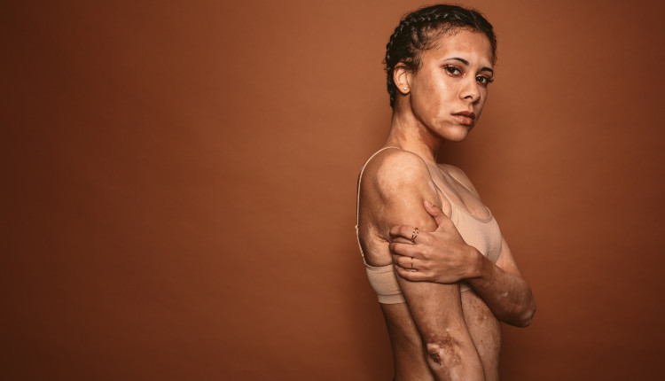 vrouw met witte vlekken op haar lichaam - vitiligo