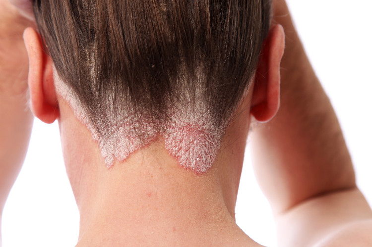 psoriasis achter in de nek