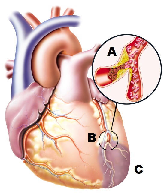 anatomische tekening van het hart met een verstopt bloedvat