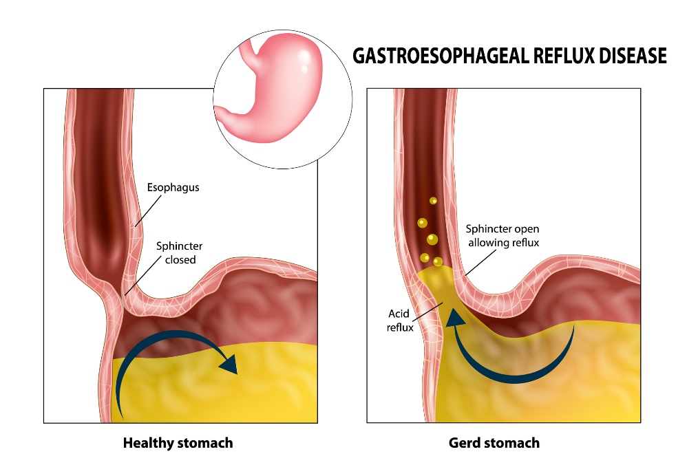 Gastro-oesofageale reflux: slokdarm, sluitspier, maag en maagzuur