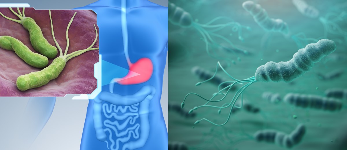 Helicobacter pylori koloniseert het maagslijmvlies en is een risicofactor voor gastritis, maagzweer en kanker.