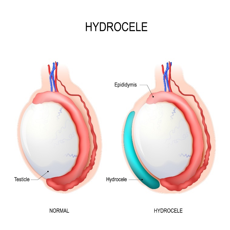 Hydrocele: Testikel (zaadbal), Epididymis (bijbal), Hydrocele (opgehoopt vocht)