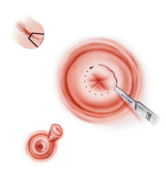 Cervicale conisatie met een scalpel