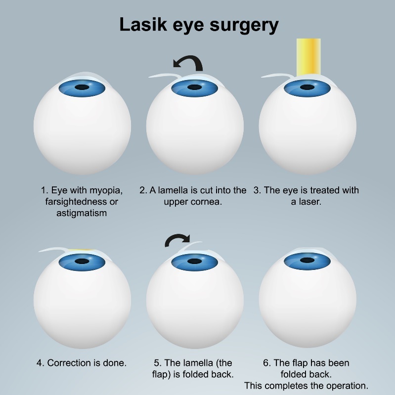 Ooglaseren LASIK - subsurface methode. Procedure met flap/flap zonder beschadiging van de zenuwuiteinden.