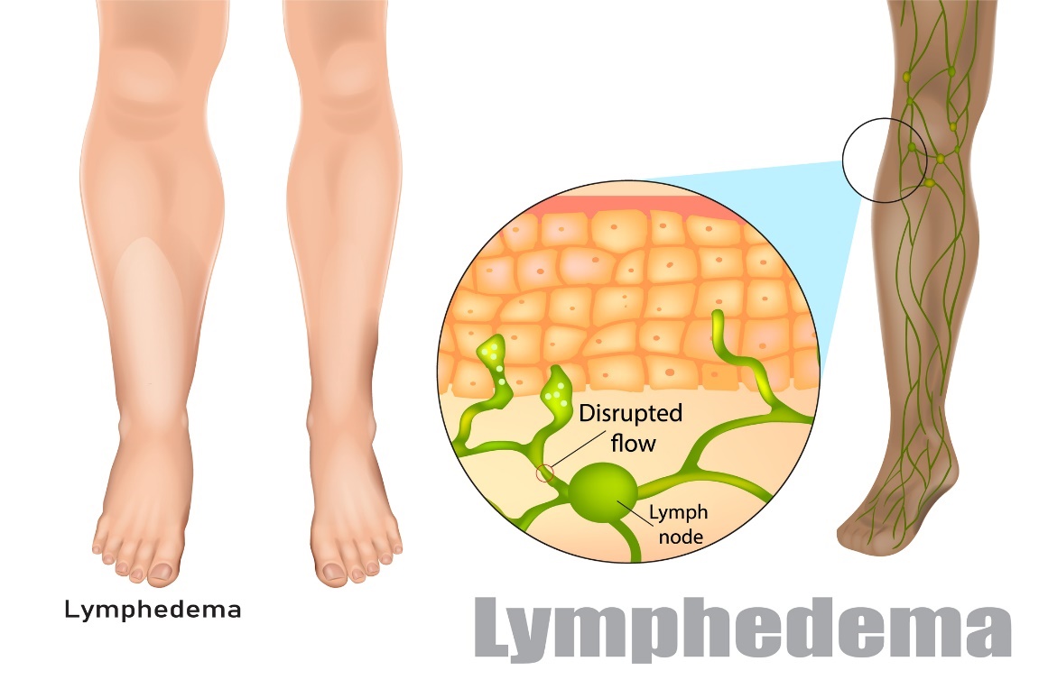 Lymfoedeem