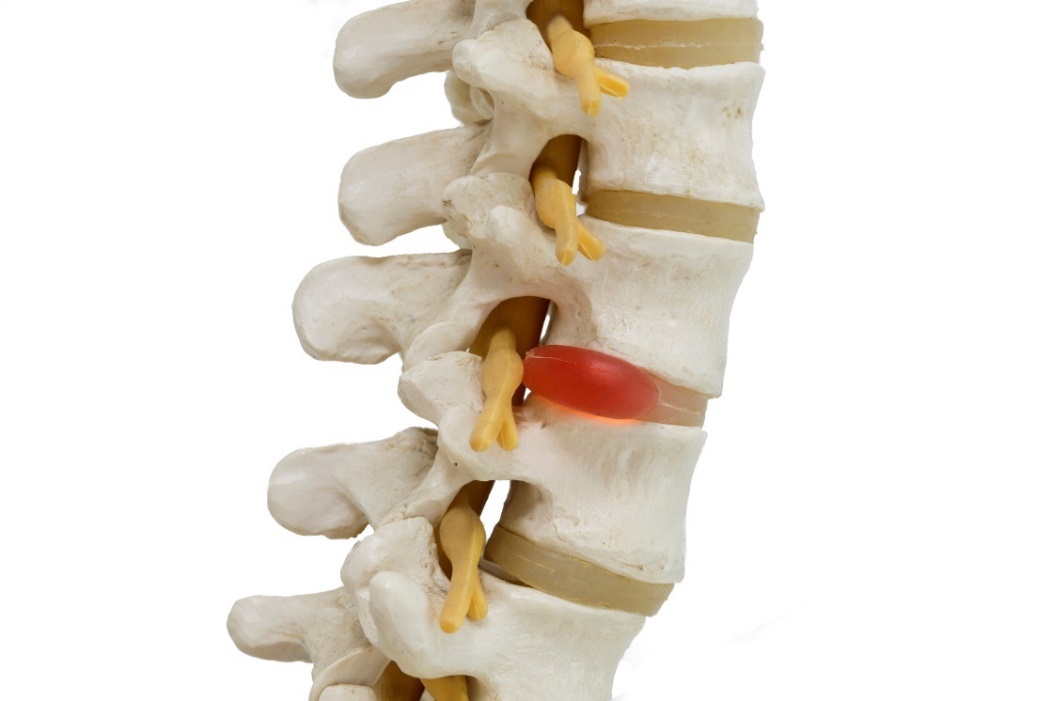 Anatomische weergave van een 3D-model van de wervelkolom, tussenwervelschijven en hernia met zenuwcompressie