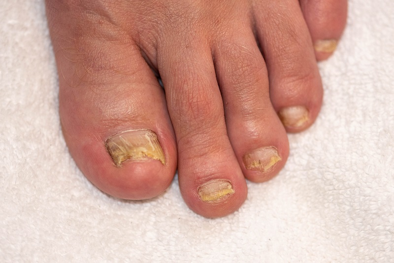 Mycotische infectie van teennagels