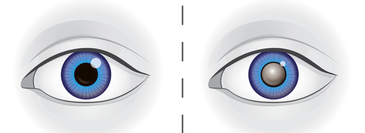 Links: een oog met een gezonde lens. Rechts: een oog met een troebele lens door staar.