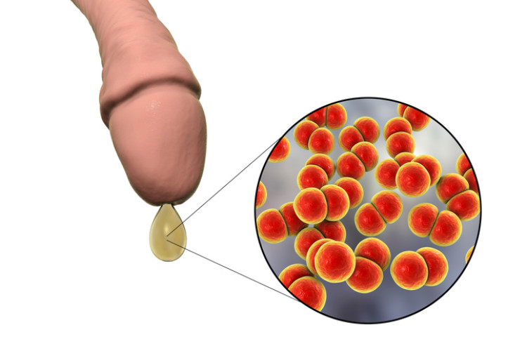 achema van de penis met afscheiding en microscopische bacteriën van gonorroe