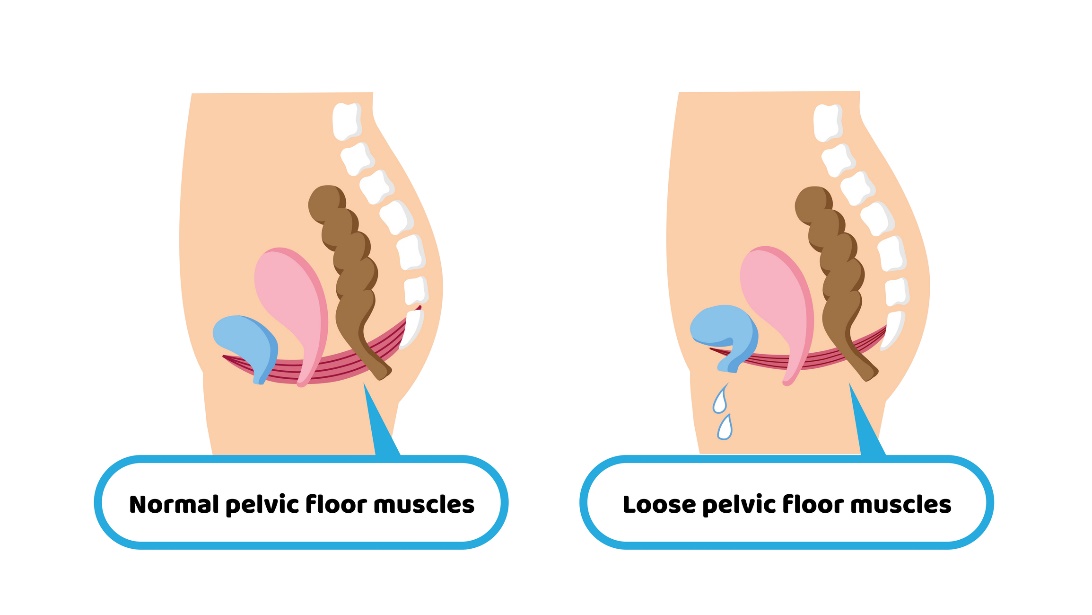 Fysiologische toestand van de bekkenbodemmusculatuur en permissieve toestand van de bekkenbodemmusculatuur met incontinentie als gevolg