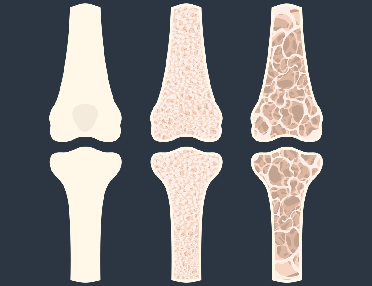 Animatie van drie botten die osteoporose laten zien - dunner wordende botten