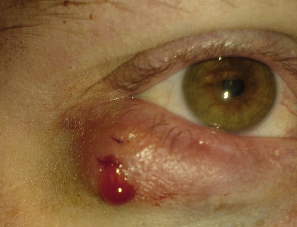 Chalazion, d.w.z. wolfskorrelbloeding na impactie, om druk te verlichten, ooglid aangetast door ontsteking, rechteroog