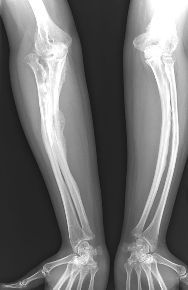 Röntgenfoto's van de ziekte van osteogenesis imperfecta bij een volwassene