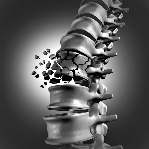 Wervelfractuur van de wervelkolom