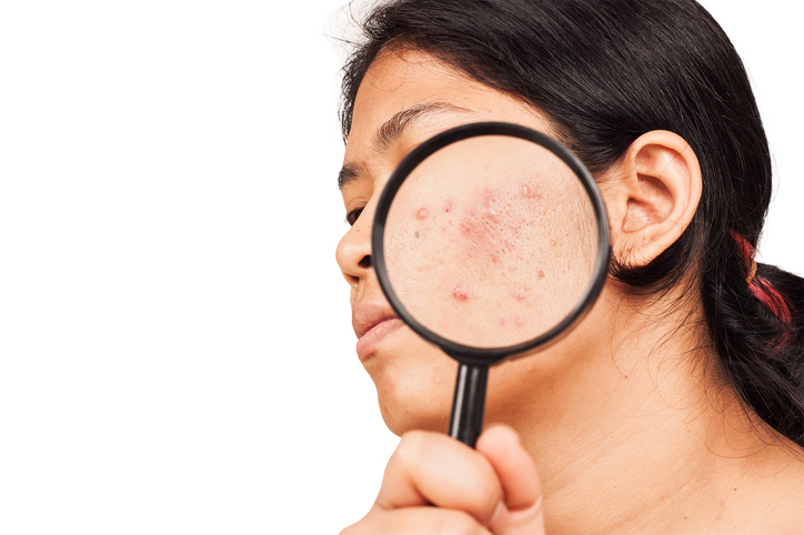 Vrouw heeft acne op gezicht, vergroting onder vergrootglas