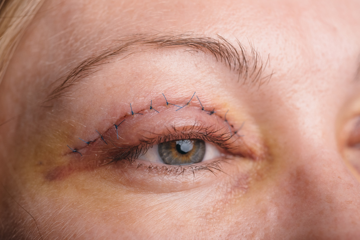 Vrouw, gezicht en ooglid na blepharoplastie - blepharoplastie