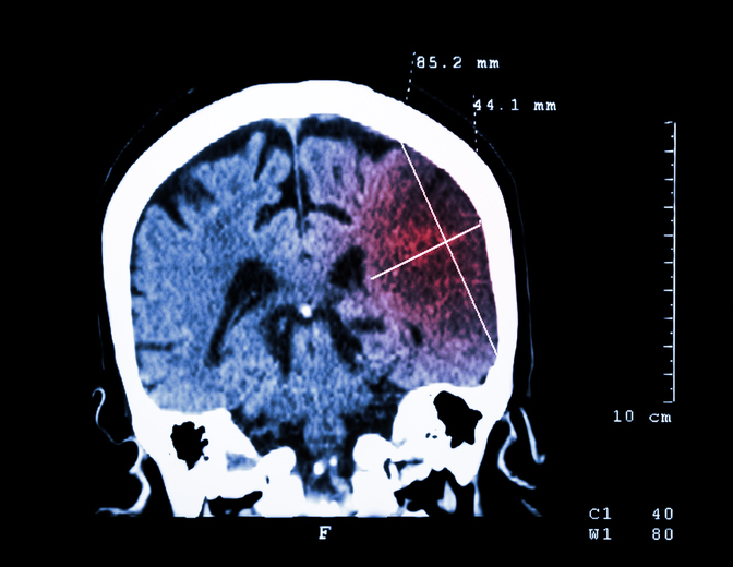 Hersenbeschadiging zichtbaar op CT-scan