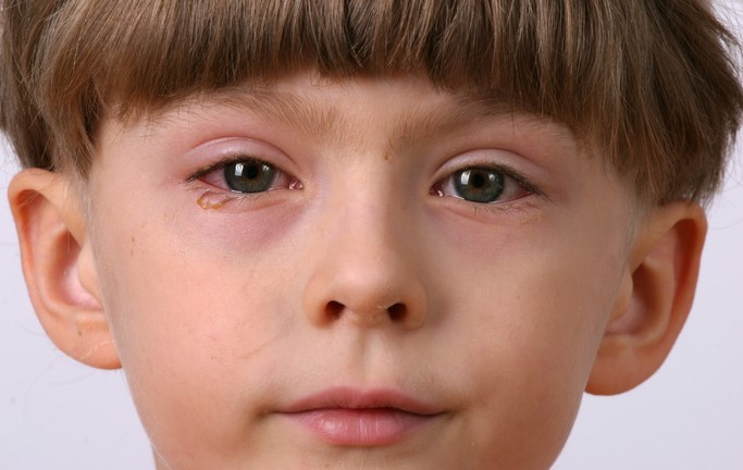 Het kind heeft ontsteking van de ogen, conjunctivitis, d.w.z. ontsteking van het bindvlies