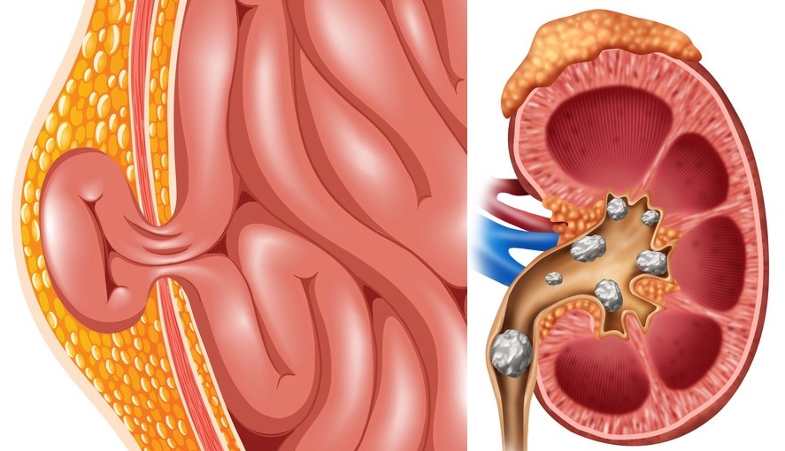 Hernia, nier- en urinestenen