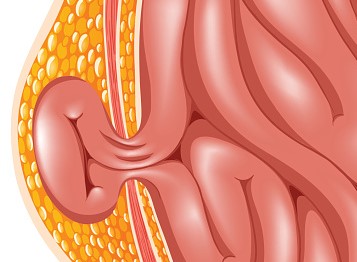 Hernia, de meest voorkomende complicatie van ascites