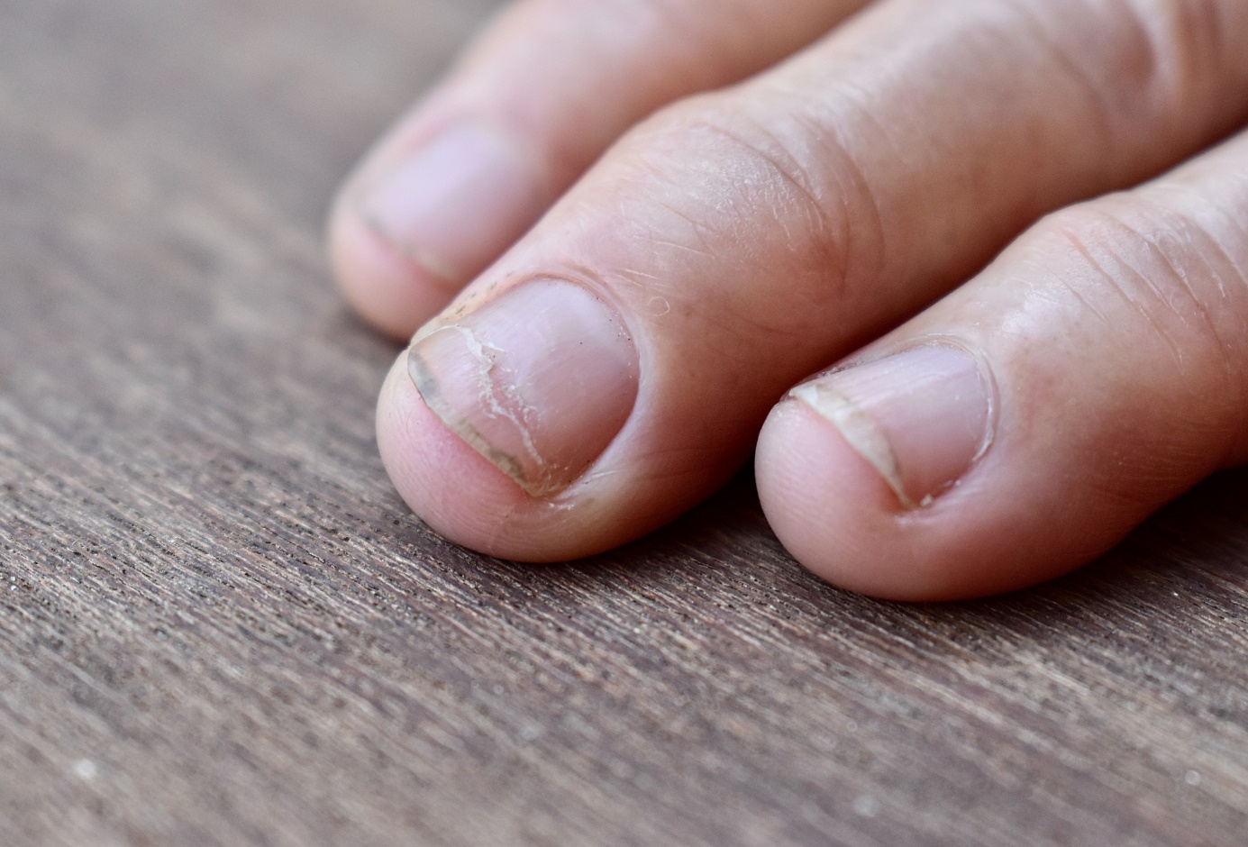 Horizontale groeven op de nagels - hand, vingers, nagels