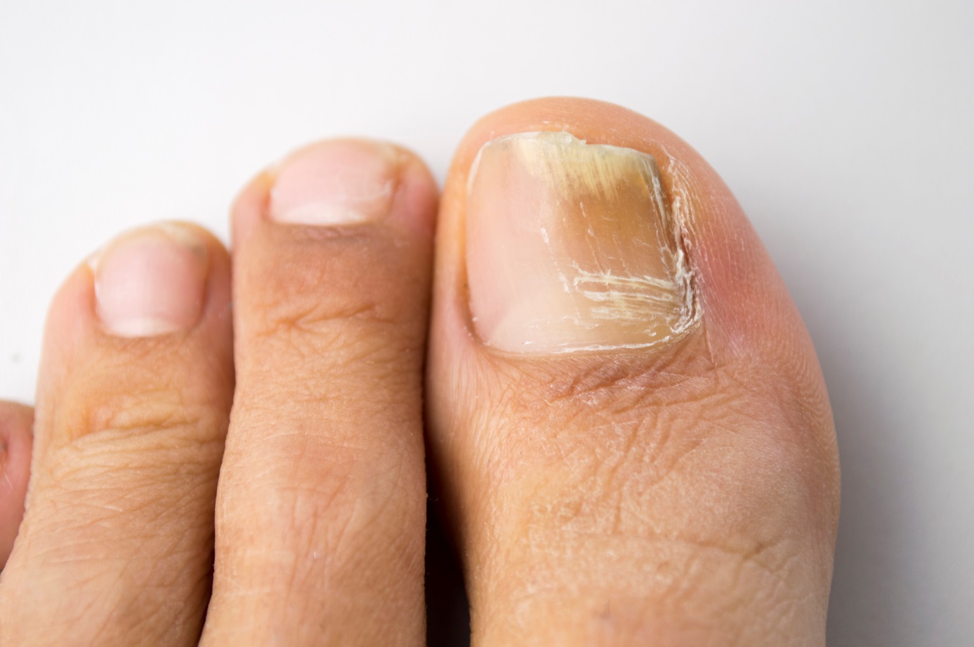 Broze nagels en zichtbare broosheid van de nagels aan de onderste ledematen, voeten.