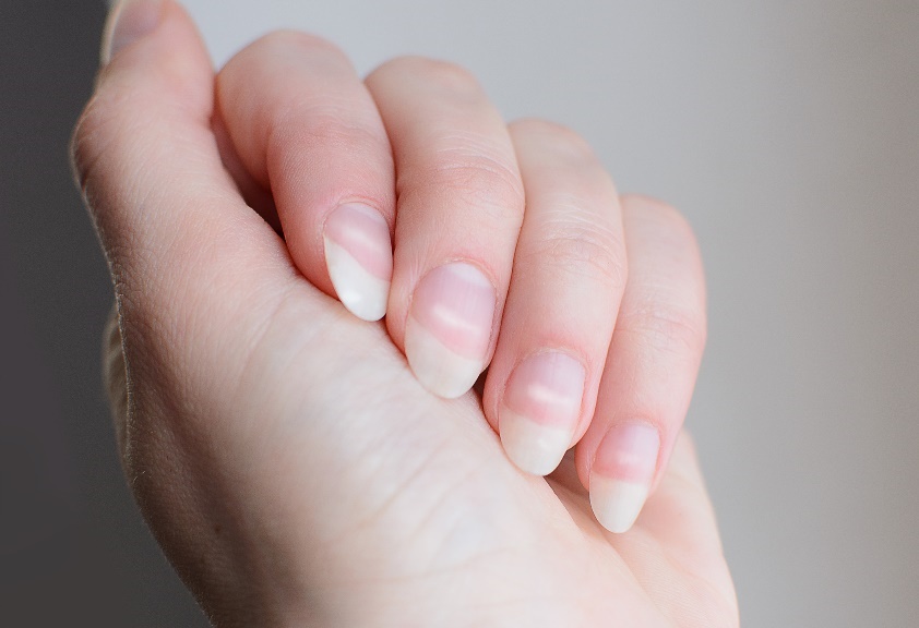 Leukonychia en vorming van witte vlekken op de nagelplaat