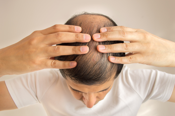 Man heeft dun haar, haaruitval, kaalheid of alopecia, handen op het hoofd, bovenaanzicht