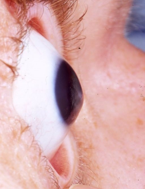 Keratoconus, degeneratie van het hoornvlies