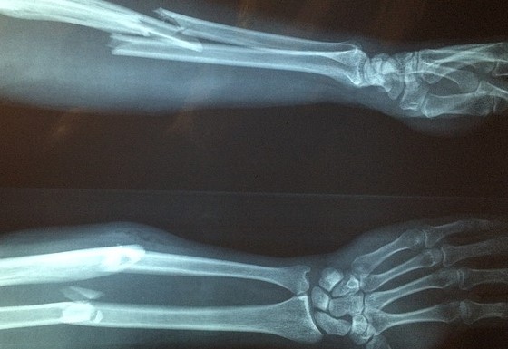 Röntgenfoto van onderarm met bewijs van onderarmfractuur, gecompliceerde fractuur met dislocatie