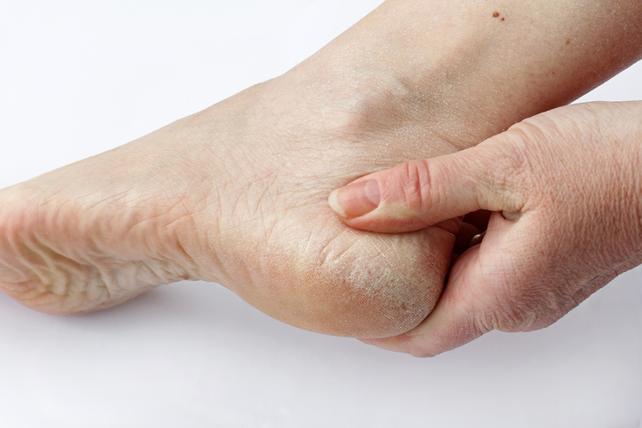 Droge huid op de voet, hiel of tussen de tenen bij schimmeldermatitis