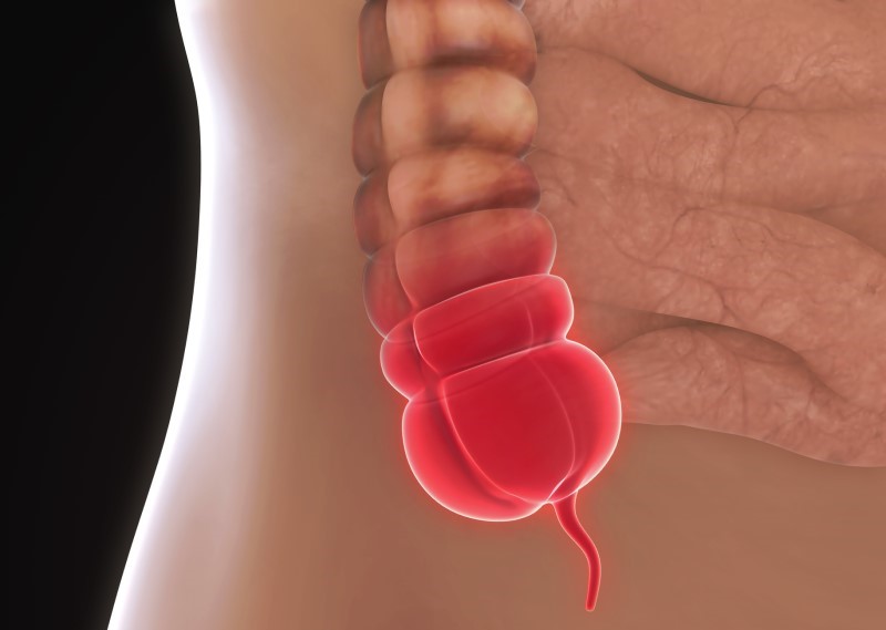 Model van ontstoken appendix - anatomisch aanzicht