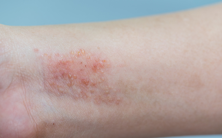 Eczeem op de polsen en onderarmen, gezwollen, rode huidontsteking zoals contactdermatitis