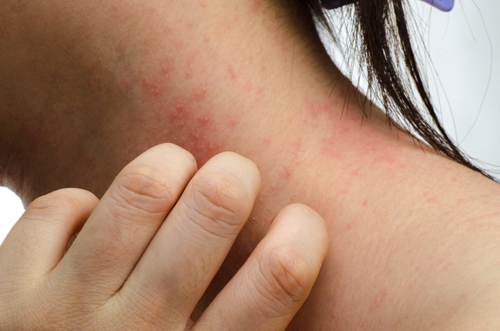 Een vrouw krabt in haar nek, jeukende huidontsteking, roodheid en uitslag in haar nek