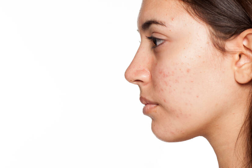 Acne: Welke vormen van acne kennen we? Hoe behandel je de huid thuis?