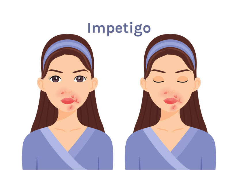 Wat is impetigo, welke symptomen heeft het? Besmettelijkheid en overdracht bij kinderen